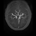 MRI angio mózgowia
